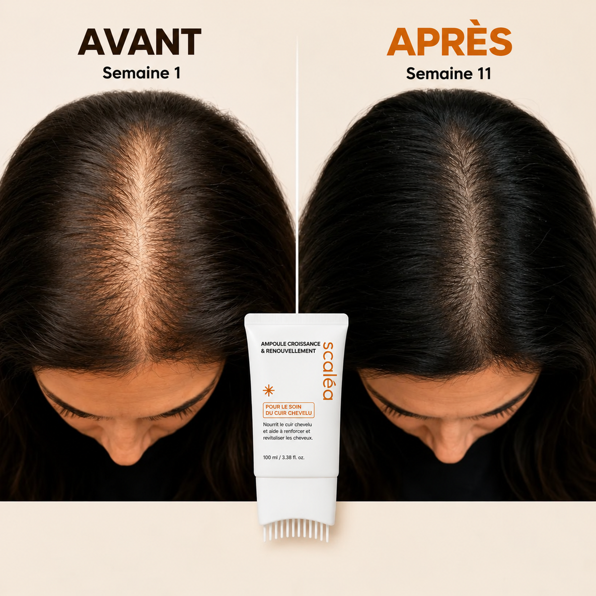 SCALÉA™ STOPPE LA CHUTE DES CHEVEUX. AIDE VOS CHEVEUX À REPOUSSER.